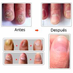 TRATAMIENTO DE HONGOS PARA UÑAS, BLANQUEAMIENTO DE UÑAS, ELIMINACION DE HONGOS, GEL ANT INFECCION, PARONIQUIA Y ONICOMICOSIS